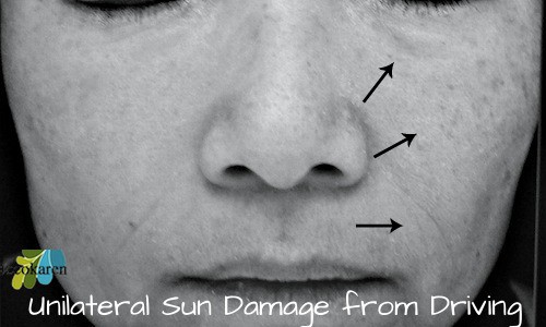 Unilateral Sun Damaged skin ecokaren